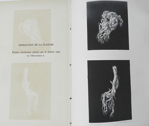 Rare la bronchite - rare,